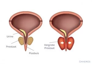 Veel plassen man door vergrote prostaat, doorsnede normale en vergrote prostaat met open en dichtgedrukte plasbuis