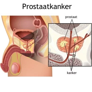 chronische prostatitis en psa waarde