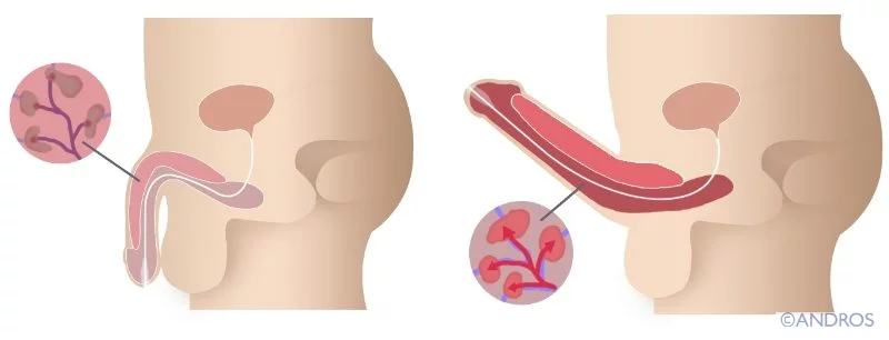 Erectieproblemen worden ervaren als de zwellichamen in de penis niet goed gevuld worden met bloed om voldoende stijfheid te bereiken