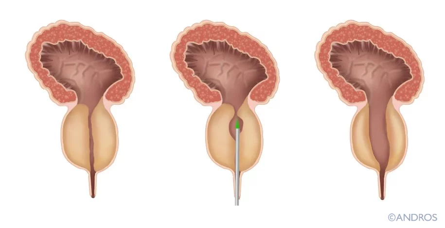 Green Light Laser Prostaat Uitleg met de laser wordt de plasbuis breder gemaakt