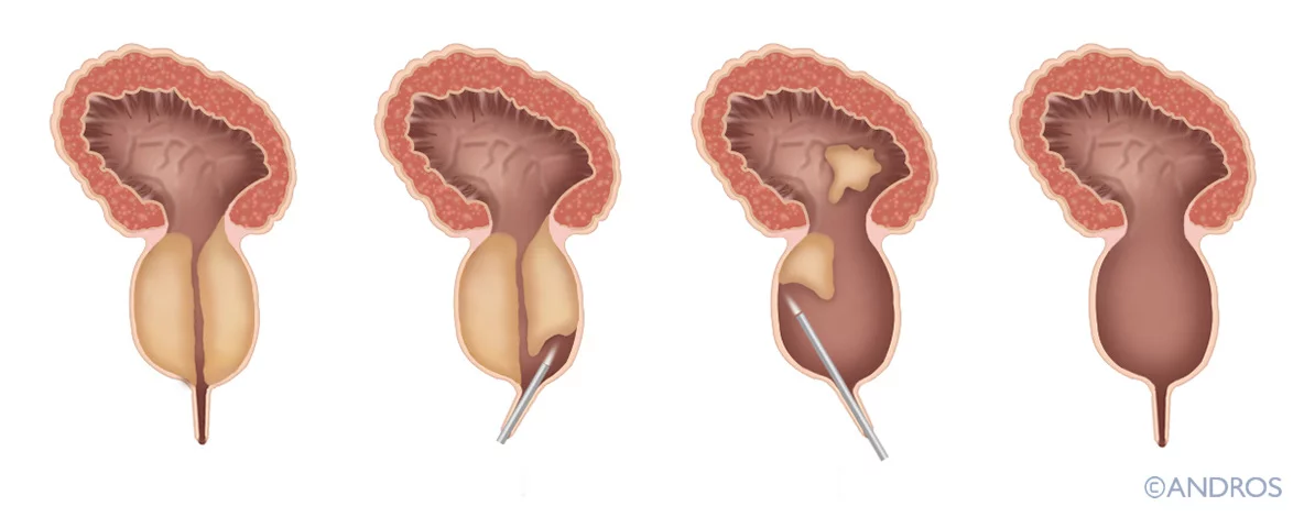 HoLEP Laser Prostaatoperatie Uitleg Andros Clinics