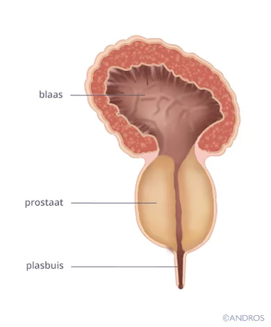 Laserbehandeling Prostaat is nodig als plasbuis wordt dichtgedrukt door prostaatweefsel
