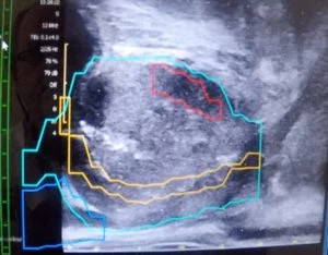 Vooor een MRI geleide prostaat biopsie worden MRI beelden over echo gezet