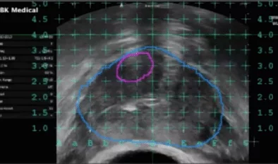 Prostaatbiopsie beelden MRI Echo fuseren in raster