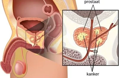 chronische prostatitis en psa waarde