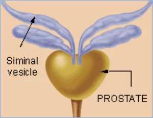 Doorsnede van de prostaat met stadium 1 prostaatkanker T1. De tumor is niet voelbaar of zichtbaar.