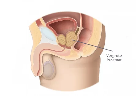 Vergrote prostaat kan tegen plasbuis of tegen blaas aan gaan drukken in de onderbuik