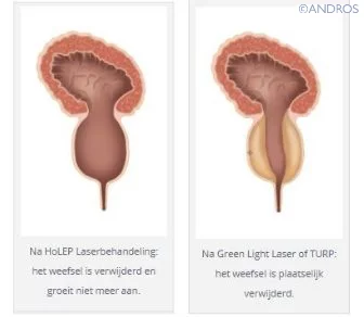 Verschil Green Light Laser en HoLEP Laser Andros Clinics