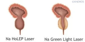 Verschil Prostaat na Green Light Laser of HoLEP Laser Andros Clinics