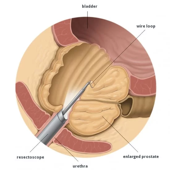 Rezecția transuretrală a prostatei (TURP) – Recuperare