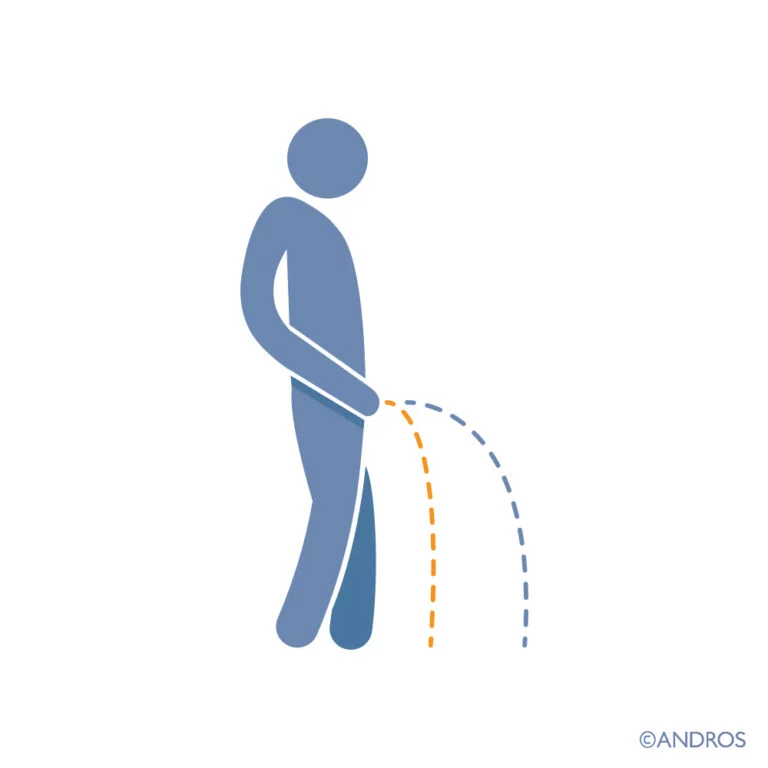 Vaak plassen en andere plasproblemen bij mannen