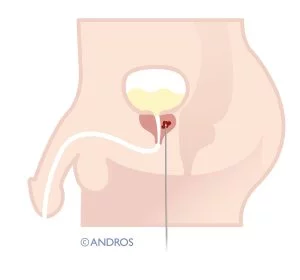 Prostaatsparende operatie prostaatkanker FLA er wordt geprikt via de huid tussen de balzak en de anus