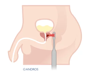 Prostaatsparende operatie prostaatkanker HIFU via de anus er wordt niet gesneden of geprikt 
