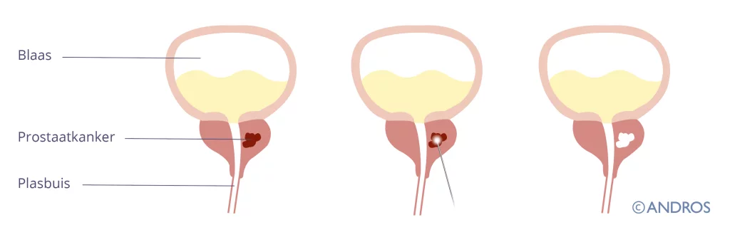 Bij FLA focale therapie blijft de prostaat en wordt alleen de tumor vernietigd met de laser met prikken via de huid